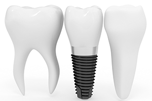 Dental Implants, Ottawa Dentist