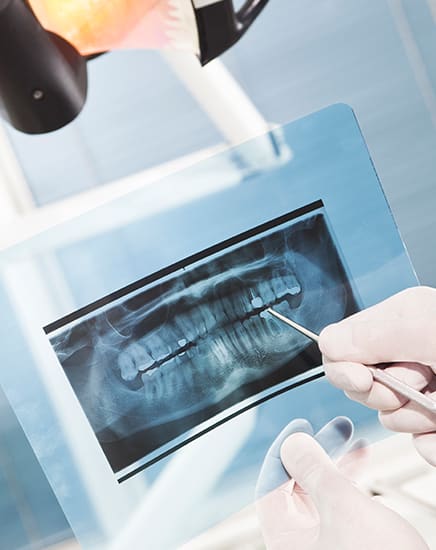 Dental X-Rays, Ottawa Dentist